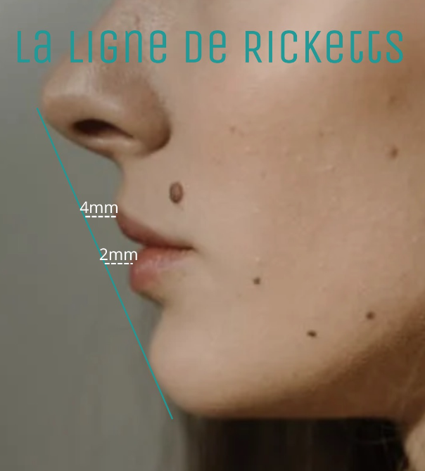 mesure du volume des lèvres grâce à la ligne de ricketts, injections lèvres